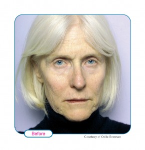 Before Sculptra