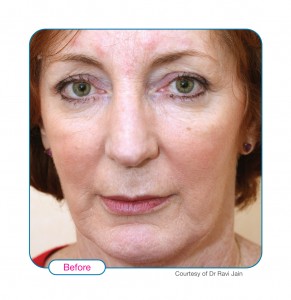 Before Sculptra2