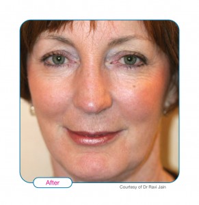 After Sculptra2