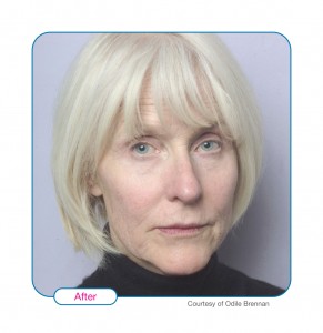 After Sculptra