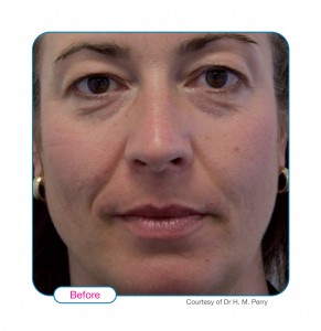 Before Sculptra1
