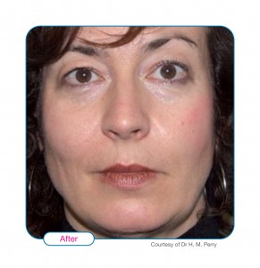 After Sculptra1
