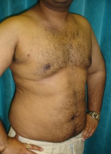 After Male Chest Reduction