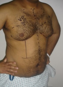 Before Male Chest Reduction