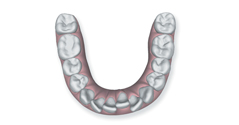 overcrowded-teeth