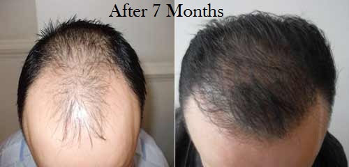 Before-After-7-months-FUE-Hair-transplan
