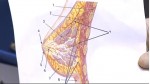 Macrolane Breast Augmentation