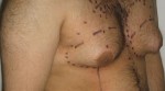Male Chest Reduction By Millimetre Perfect