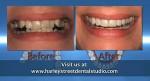 Invisalign orthodontics described by Harley Street Dental