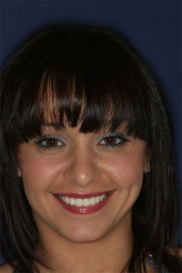 After treatment by Barry Oulton at Haslemere Dental Center Surrey After treatment by Barry Oulton at Haslemere Dental Center Surrey