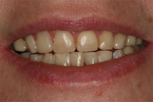After treatment by Barry Oulton at Haslemere Dental Centre Surrey