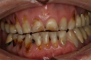 Before treatment by Barry Oulton at Haslemere Dental Centre Surrey