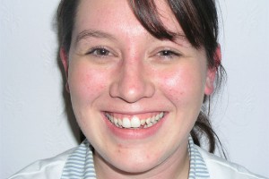 Before treatment by Barry Oulton at Haslemere Dental Centre Surrey