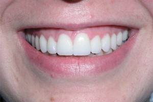 After treatment by Barry Oulton at Haslemere Dental Centre Surrey