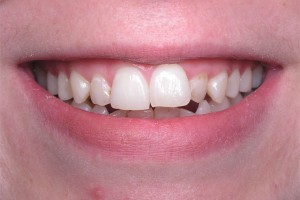 Before treatment by Barry Oulton at Haslemere Dental Centre Surrey