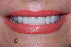 After treatment by Barry Oulton at Haslemere Dental Centre Surrey