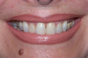 Before treatment by Barry Oulton at Haslemere Dental Centre Surrey