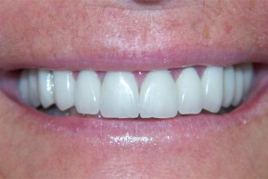 After treatment by Barry Oulton at Haslemere Dental Centre Surrey