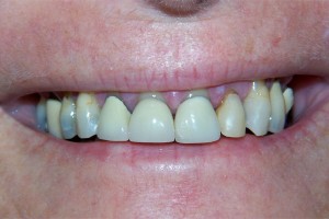 Before treatment by Barry Oulton at Haslemere Dental Centre Surrey