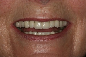 After treatment by Barry Oulton at Haslemere Dental Centre Surrey