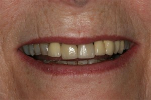 Before treatment by Barry Oulton at Haslemere Dental Centre Surrey