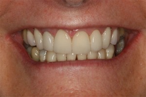After treatment by Barry Oulton at Haslemere Dental Centre Surrey