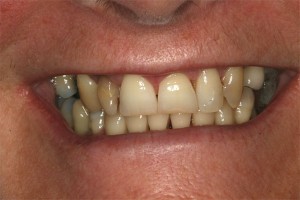 Before treatment by Barry Oulton at Haslemere Dental Centre Surrey