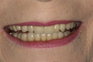 After treatment by Barry Oulton at Haslemere Dental Centre Surrey