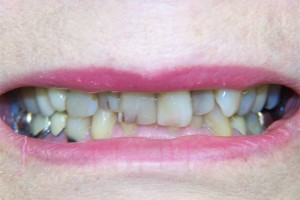 Before treatment by Barry Oulton at Haslemere Dental Centre Surrey