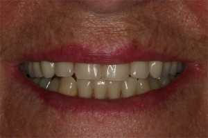 After treatment by Barry Oulton at Haslemere Dental Centre Surrey