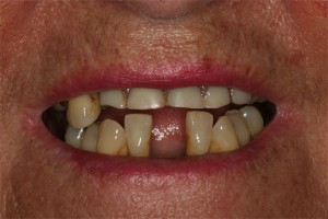 Before treatment by Barry Oulton at Haslemere Dental Centre Surrey