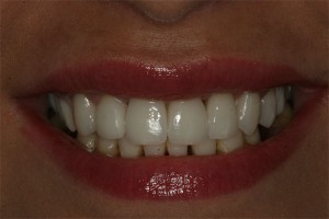 After treatment by Barry Oulton at Haslemere Dental Centre Surrey
