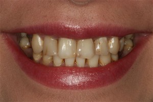 Before treatment by Barry Oulton at Haslemere Dental Centre Surrey