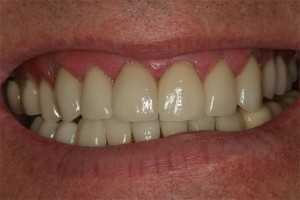 After treatment by Barry Oulton at Haslemere Dental Centre Surrey