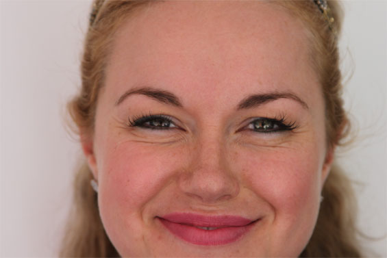 Dr Kuldeep Minocha Urban Spa Beauty Essex Botox Before
