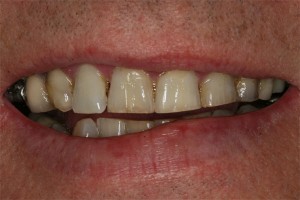 Before treatment by Barry Oulton at Haslemere Dental Centre Surrey