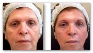  woman of 72 years old treated with meder visage 