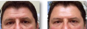 meder wrtinkle reduction on man