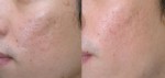 chemical-peels-before-and-after