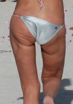cellulite